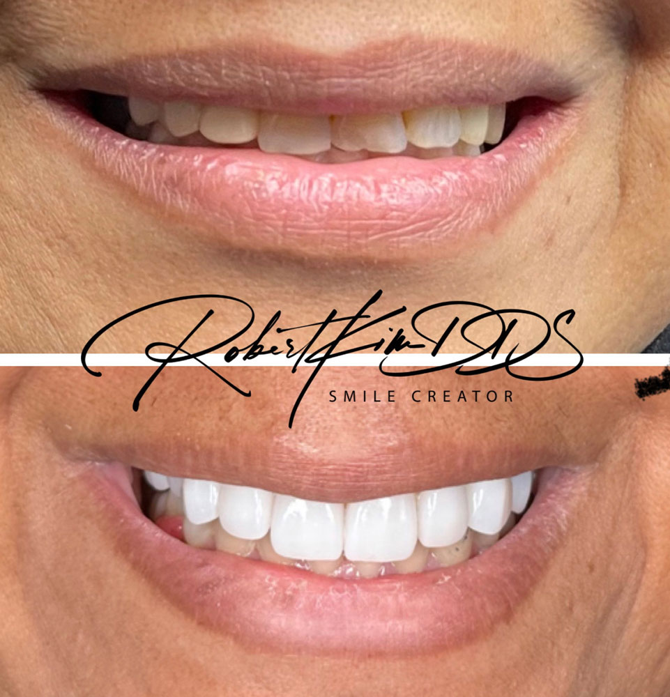 veneers chino hills ca