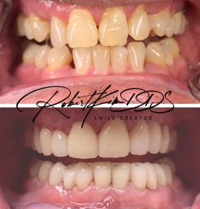 full arch dental implants chino hills ca