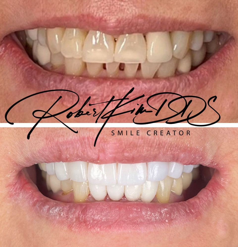 Porcelain Veneers Chino hills
