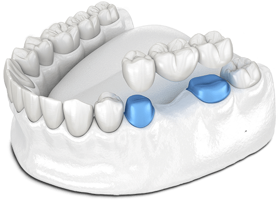 dental bridge chino hills 