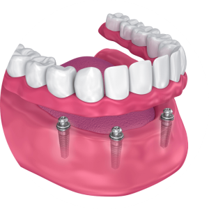 implant dentures chino hills