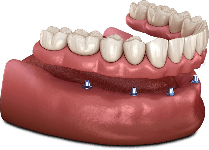 implant dentures chino hills 
