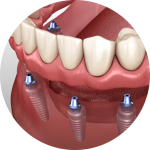 implant-supported-dentures-southern-california