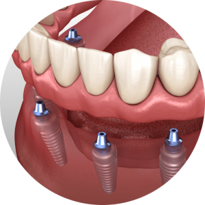 implant-supported-dentures-southern-california