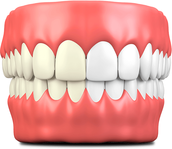 teeth-whitening-chino hills
